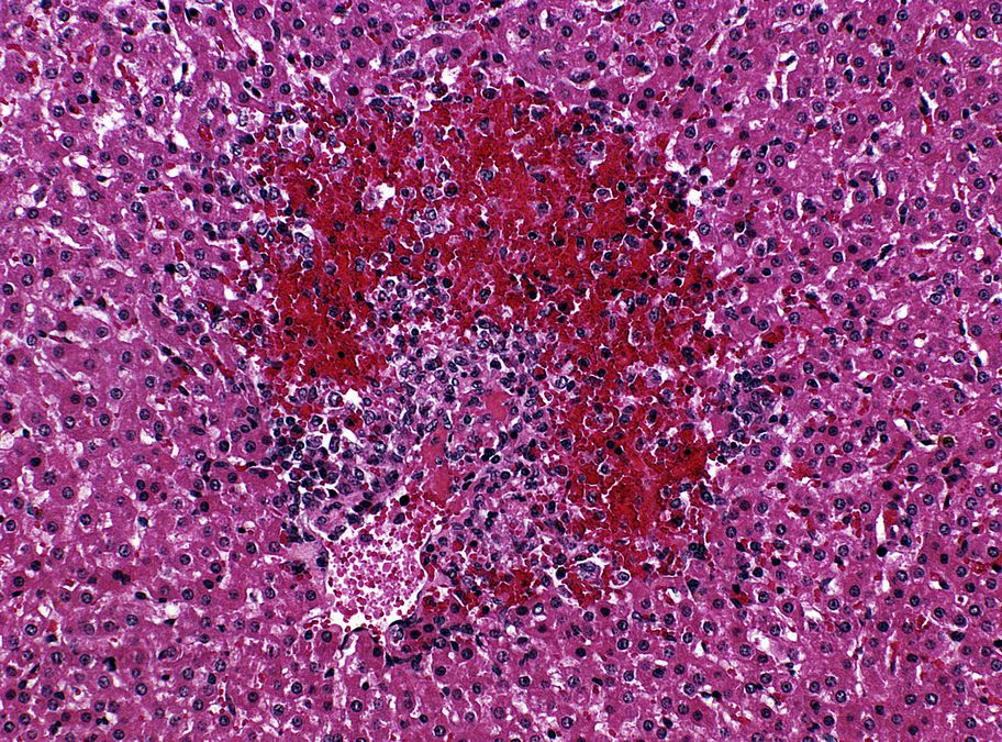 zur Vergrößerungsansicht des Bildes: Histologisches Präparat mit zentrolobulärer Herdnekrose mit Blutung und Thrombus in der Leber bei 200-facher Vergrößerung