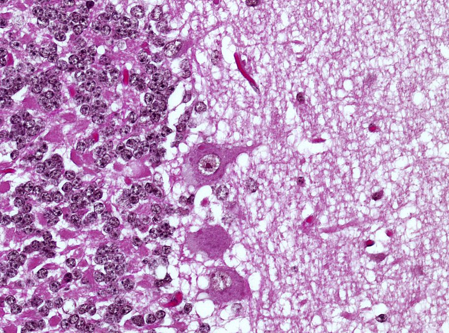 Histologisches Präparat von Negri-Körperchen in Purkinje-Zellen des Kleinhirns bei 400-facher Vergrößerung