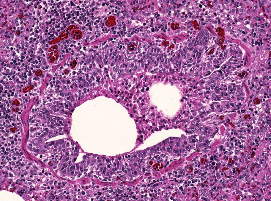 Histologisches Präparat einer katarrhalisch-eitrigen Bronchiolitis beim Schwein bei 200-facher Vergrößerung