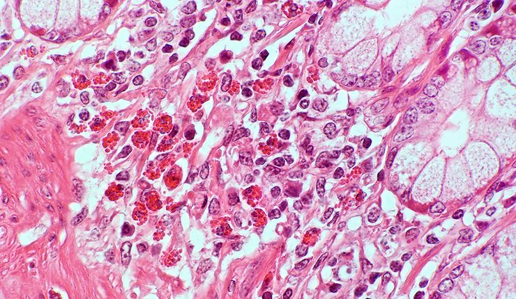 Histologisches Präparat von eosinophilen Granulozyten in der Darmschleimhaut bei 400-facher Vergrößerung)