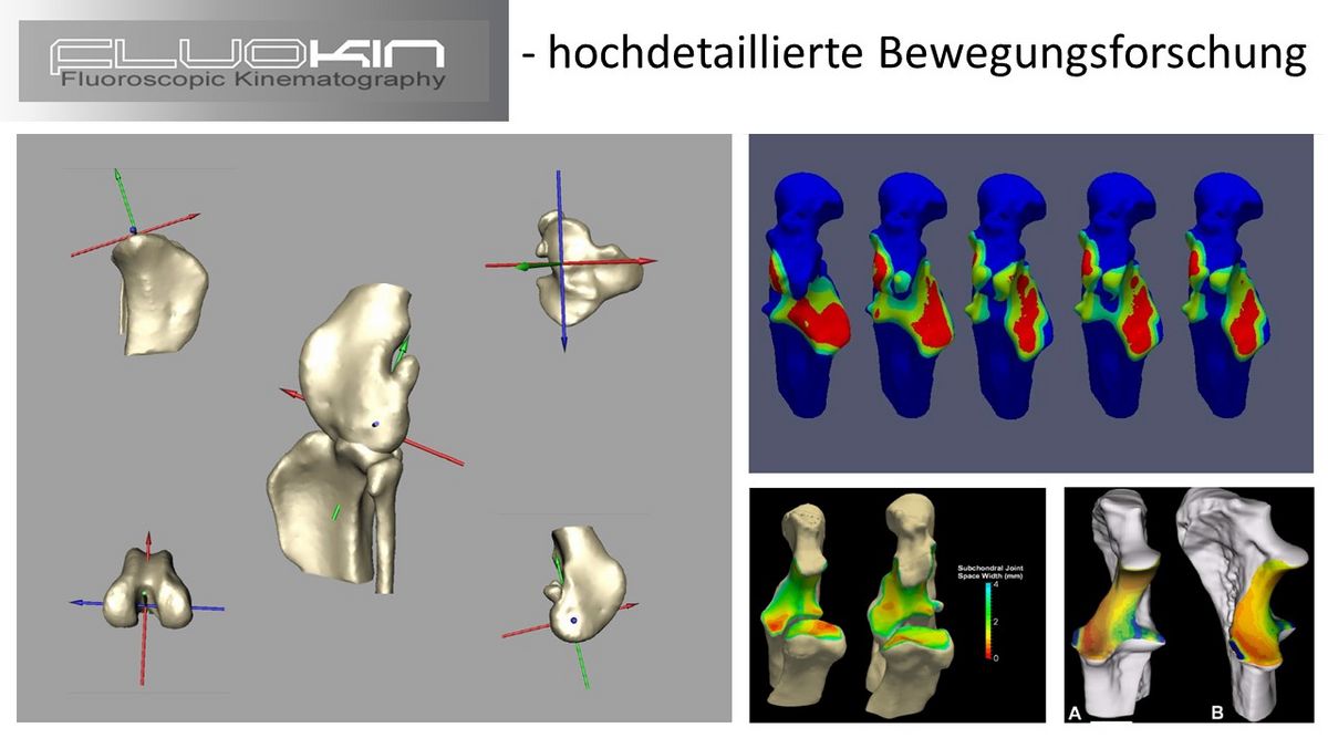 zur Vergrößerungsansicht des Bildes: An computer-animierten 3D-Modellen untersuchen die Forscher, anschließend an die FluoKin-Aufnahmen, Bewegungen wie auch die Kontaktflächen innerhalb von Gelenken. Grafik: Peter Böttcher
