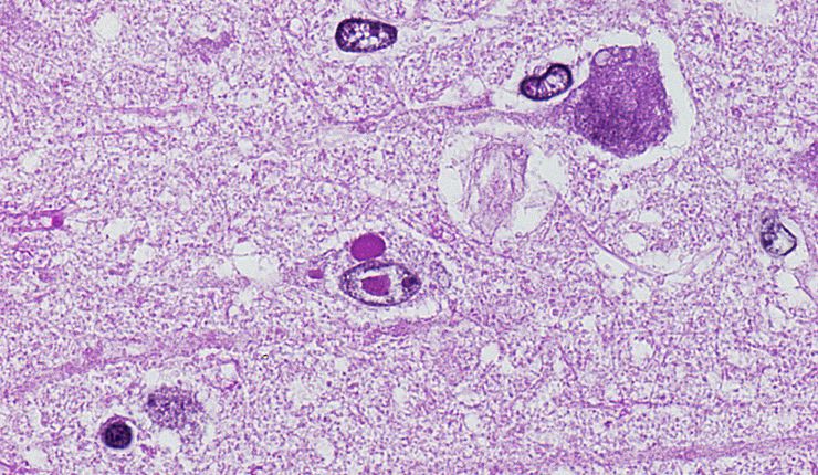 Histologisches Präparat von Einschlusskörperchen in Neuronen der Großhirnrinde durch Staupevirusinfektion bei 1000-facher Vergrößerung
