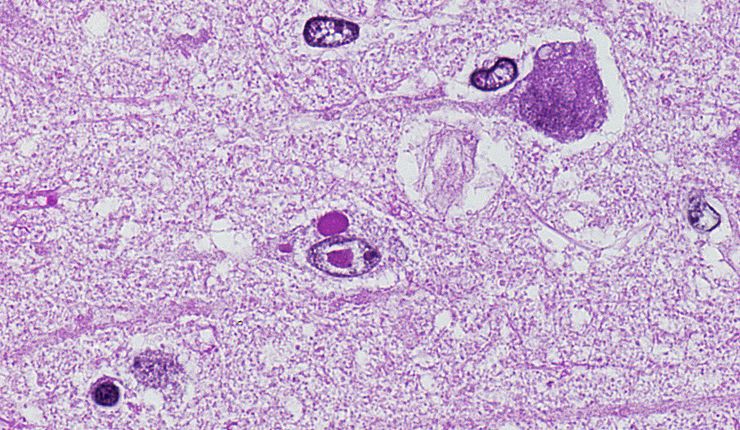 Histologisches Präparat von Einschlusskörperchen in Neuronen der Großhirnrinde durch Staupevirusinfektion bei 1000-facher Vergrößerung