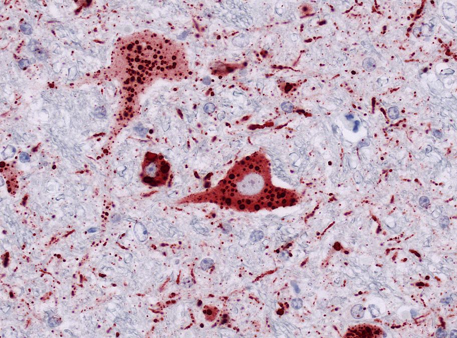 Immunhistologischer Nachweis von Tollwut-Virusantigen in Nervenzellen der Medulla oblongata bei 400-facher Vergößerung