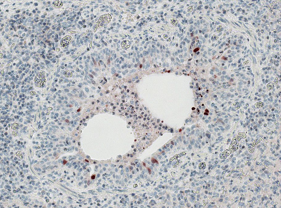 zur Vergrößerungsansicht des Bildes: Intraläsionaler immunhistologischer Nachweis von Influenza-A-Virusantigen im Bronchiolus einer Schweinelunge bei 200-facher Vergrößerung